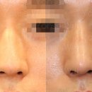 형이비인후과의원 | [무보형물 코성형 1례 + 보형물 코성형 1례] 전후 비교