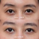 그레이스오앤영성형외과의원 | 눈두덩이 지방이식 후기·전후가 중요한 이유 │그레이스성형외과