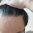 두피 엑소좀 후기(10번중 첫번째 시술)