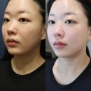 디자인듀오 | 신사동성형외과 가성비 울쎄라 비올 듀오타이트리프팅 후기