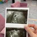 역전자동차병원 | 임신 4주차 일기｜첫 산부인과 방문과 보건소 등록 (+미사린산부인과후기)