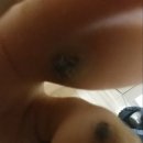 벽촌한의원 | 사마귀와의 혈투