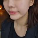 좋은날피부과의원 | 강남 피부과 의원 내돈내산 울쎄라 티타늄리프팅 통증 후기