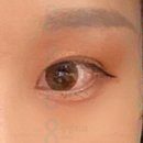 아이브성형외과의원 | 인라인 쌍꺼풀 후기 연예인 같이 예쁘게