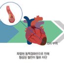 심근경색 전조 원인 심근경색 음식 예방법 이미지