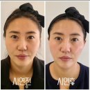 (사)국제장애인문화교류계양구협회 | 피부초음파기기만 했을뿐인데 주변에서 양악수술 한줄 알아요