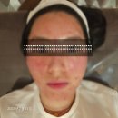 고피부과의원 | 25.02.01 - 순천 더미라클의원 피부과 후기 (내돈내산)