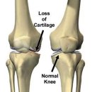 류마티스 관절염(Rheumatoid Arthritis) 이미지