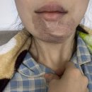 마스크성형외과의원 | 함희정 성형외과의원 흉터제거 후기 (일주일 후기)