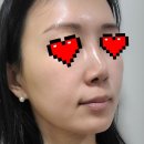 [내돈내산]시지경산 피부과 리뉴한의원 엑소좀 스킨부스터 후기