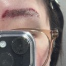 김민정치과의원 | 눈물의 눈썹 문신 제거 1회차 후기