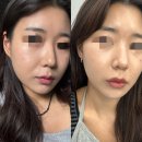 윤곽의정석성형외과 | 신사역 얼굴 실리프팅 받고 온 찐후기 실리프팅 전문병원 !!