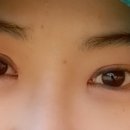 신안과의원 | 대전 신안과/신안과 안검하수 후기/안검하수 일주일후기,비용