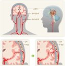 [간편]뇌혈관질환 진단비(1년50%) 특별약관 이미지