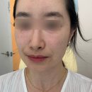 마레피부과 | 부산 연산역피부과 고우리 스킨부스터 후기