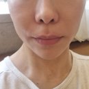 전격 | 삼성동피부과 2세대 마이크로웨이브 미글로우리프팅과 온다리프팅 전격 비교 후기