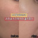 리즈멍 | [대구동성로리즈네] 대구 물광주사 리즈네 스킨부스터 솔직후기