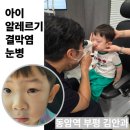 부평건강약국 | 아이 알레르기 결막염 눈병 재방문 부평김안과