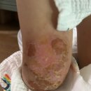 경산영남한의원 | 김천시 아토피피부염 치료 잘 하는곳 아토5분