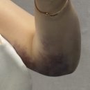 교대(2)역 | 팔뚝 지방추출주사 교대역 멍 뭉침 2주차 솔직후기