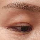 씨앤미의원경주점 | 경주씨앤미 한관종 제거 CO2레이저 1차 후 1년 후기