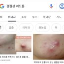 돌땡이 같은 여드름 녹여버린 9천원 짜리 식약처 인증 폼클렌징 영업한담 이미지