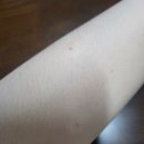 목동사이렌의원 | 목동사이렌의원_점빼고 3주 차 상태 후기