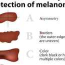 피부암 점과 다른 특징 초기증상 및 예방법 이미지