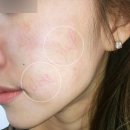 닥터오케이메디칼 | 피부재생주사 3회차 내돈내산 솔직후기 +비포애프터