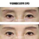디비성형외과의원 | 눈재수술후기 분석을 통한 비대칭 교정 핵심 전략