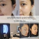 세븐일레븐 대구범어대로점 | 범어역피부과 대구피코토닝 레이저토닝 10회차 전후비교 최종 후기