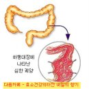 염증성장질환(크론병,궤양성대장염) - 피부 멜라닌종 위험 이미지