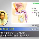 [고환/비뇨기과/코넬비뇨기과]여학생이 남자의 고환을 파열시켰다고! 이미지