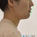 서울클리어치과교정과 치과의원 | 길음 교정치과, 잔존 유치와 총생 케이스 교정 치료