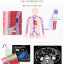 오래 앉아 있으면, 혈전증(血栓症) 발생 이미지