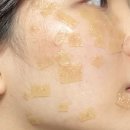 서울바른약국 | 서울 저렴하게 편평사마귀 무제한으로 없앤 내돈내산 후기 (10일차)