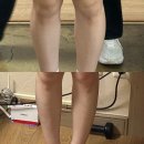 우주사 | 청담 피부과 종아리알+지방까지 잡아주는 종아리하이힐주사 솔직 시술 전 후 후기