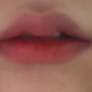 연세미사랑의원 | 연세미사랑의원 입술필러 (3주+4일) 솔직후기