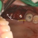 건강제일의료소비자생활협동조합 굿모닝치과의원 | 잇몸이 부었을때 제때 치료하지 않는다면, 길동 치과 잇몸이식술과 상악동거상 케이스