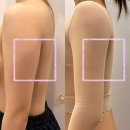 마레메디칼 | [대전 팔뚝지방흡입] 수술하기전 모든 것 + 당일 후기, 준비물, 고통, 압박복 추천 :: 1주차