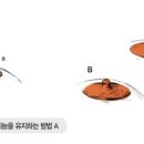 [에이블성형외과] 유두축소 이미지