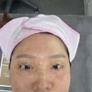 샤인 | 잠실새내 피부과 리쥬란힐러더마샤인 후기) 속보습 채운 스킨부스터 관리
