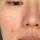 그린P(플라스틱) | 모공 고민이 있어서 한 달간 써본 성분에디터 그린토마토 앰플 내돈내산이고 비포 에프터 사진있음!!