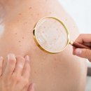다사 여드름치료? 돈 날리고 싶지 않다면 필독
