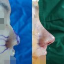 기능코 수술과 무보형물 코성형을 같이하면? [기능코, 코끝(기증늑 + 귀연골), 비순각교정, 비주교정...