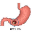 진행성 위암[Advanced gastric cancer]소화기질환, 종양혈액질환 이미지