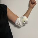 (주)레이케어 | 천호 팔뚝지방추출주사 시술 당일~일주일 후기 (멍,붓기,통증,오레지케어)