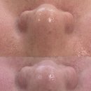 (주)에프알메디칼랩 | [코 모공] 블랙헤드만 뽑으면 끝? 반복되는 피지 고민, 해결의 핵심은 ‘균형관리’입니다