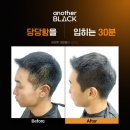 동탄 남자 탈모 두피컬러링 두피페이팅 두피염색 어나더블랙 스칼픽