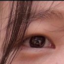 여우꼬리 | 눈밑지방재배치 내돈내산 후기_여우눈, 붓기 2주 경과 후기